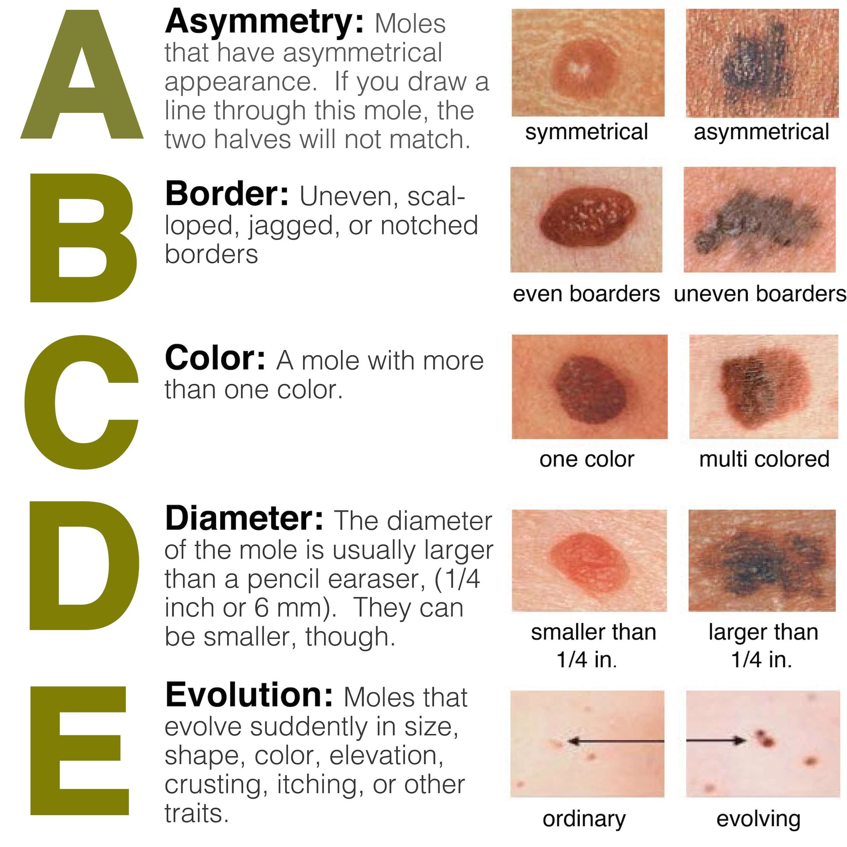 May is Skin Cancer Awareness Month Skin Cancer is an Equal Opportunity Abcd Chart For Moles